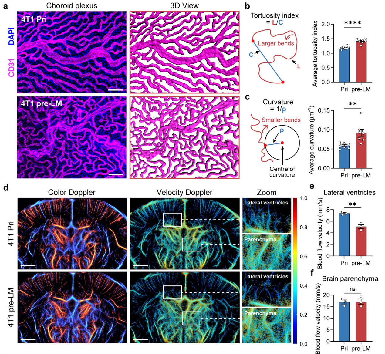 脑科学转化研究院迟喻丹团队最新研究：从血管“异化”到中枢入侵，揭示脑膜转移瘤早期防治新路径